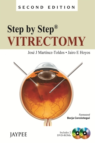 Step by Step: Vitrectomy