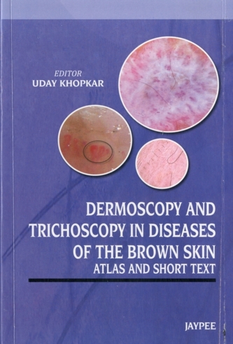 Dermoscopy and Trichoscopy in Diseases of the Brown Skin