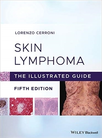 Skin Lymphoma
