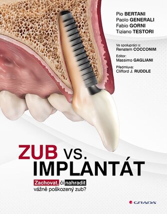 Zub vs. implantát - Zachovat, či nahradit vážně poškozený zub?