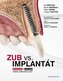 Zub vs. implantát - Zachovat, či nahradit vážně poškozený zub?