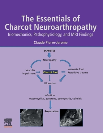 The Essentials of Charcot Neuroarthropathy