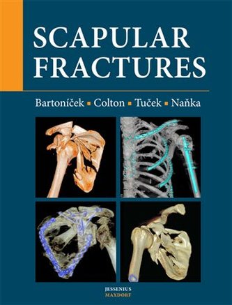 Scapular fractures Scapular fractures