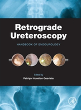 Retrograde Ureteroscopy