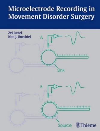 Microelectrode Recording in Movement Disorder Surgery