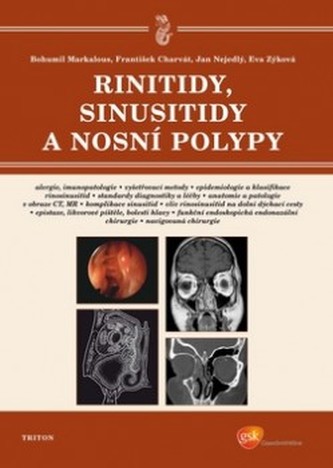 Rinitidy, sinusitidy a nosní polypy Rinitidy, sinusitidy a nosní polypy